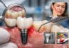 Semne că implantul dentar ar putea avea o problemă elveto-dent.ro